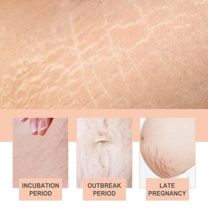 OWILIWO Silicone Belly Patches – Reusable Patch for Stretch Marks & Wrinkles (2pcs)