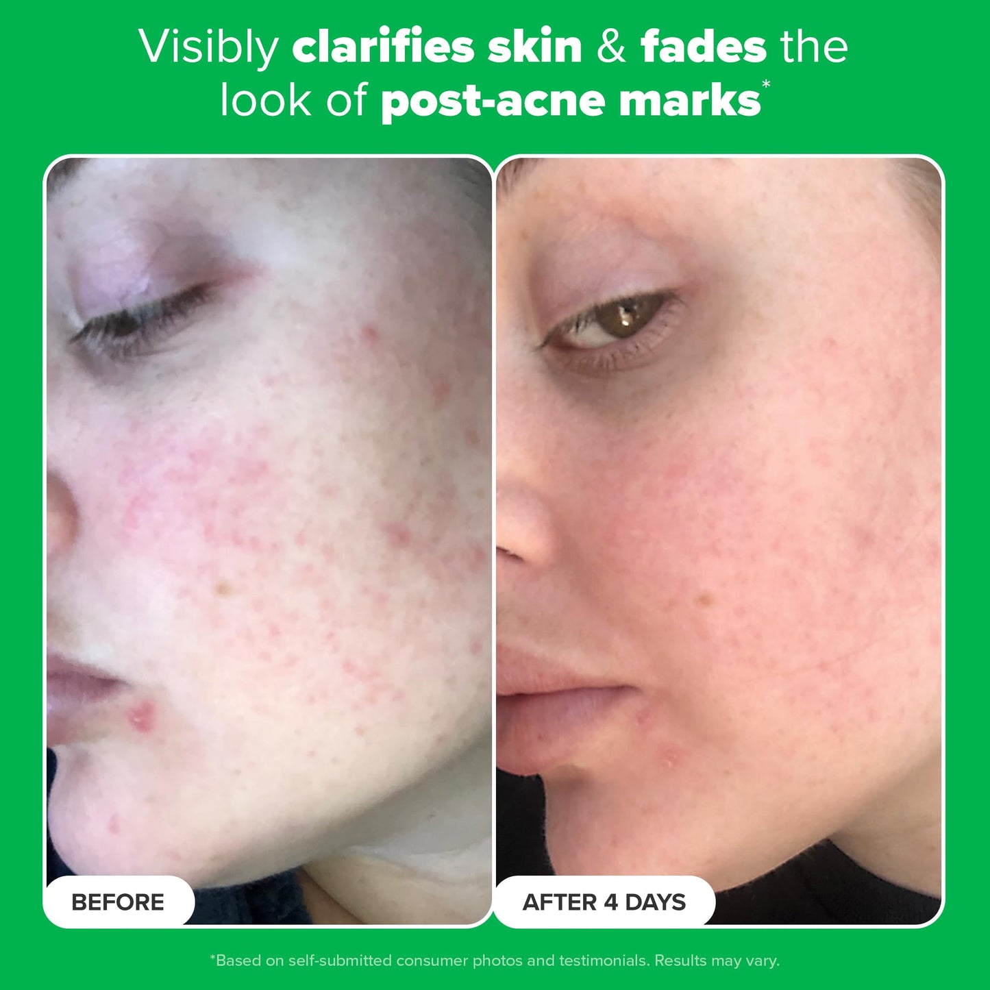 Paula's Choice BOOST 10% Azelaic Acid Booster Cream Gel – Fragrance-Free, Oil-Free Serum (0.17 fl oz)