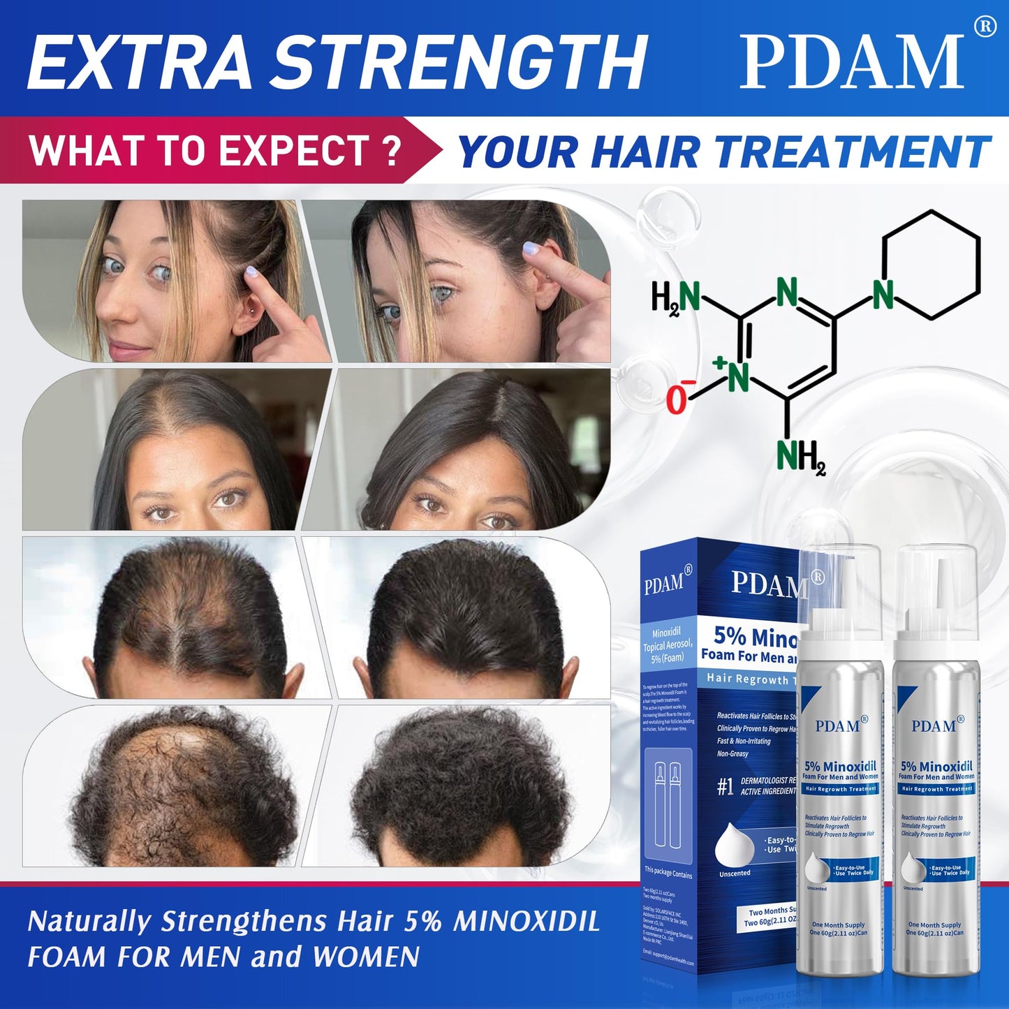 Pdam 5% Minoxidil Foam for Men & Women – Hair Growth Treatment (2 x 2.11 oz)