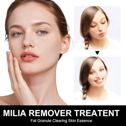 Platicat Milia Remover Serum – Clear Skin Spot Treatment (30ml, 1 Count, Black)