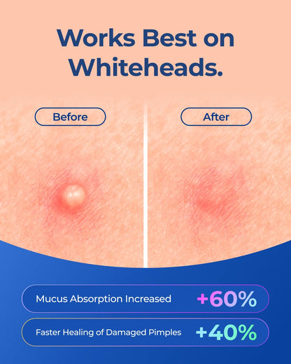 POINTMASS Star Pimple Patches – 6 Colors, 312 Patches, Overnight Care