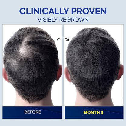ProBliva 5% Minoxidil for Men Spray – Extra Strength Hair Growth Solution (2 fl oz, Made in USA)