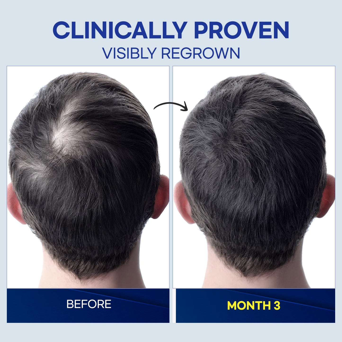 ProBliva Minoxidil 5% Hair Growth Spray – Made in USA (Pack of 2, 2 oz each)