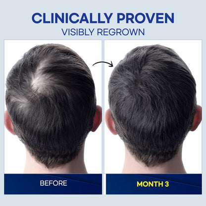 ProBliva Minoxidil 5% Hair Growth Spray – Made in USA (Pack of 2, 2 oz each)