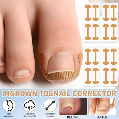 Professional Pedicure Tools Ingrown Toenail Kit – 4-Piece Set with Breathable Corrector Strips, Curved Patches, File & Lifters