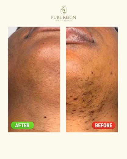 Pure Reign Skin Care Solution | Ingrown Hairs, Razor Bumps & Shaving Aftercare | 5oz (150ml)
