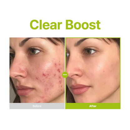 PURITO Azelaic Acid 10% + Kojic Acid + Tea Tree Serum – Acne & Marks (30mL)