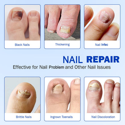 Qing Yo Nail Patches – 21 Pcs Overnight Nail Repair, Extra-Strength Patches for Thick, Discolored Nails