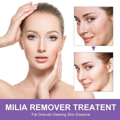 QKDBLWX Milia Remover for Eyes & Face — Salicylic Acid Milia Spot Treatment & Acne Cream