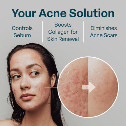 QRxLabs Salicylic & Glycolic Acid Acne Clearing Pads - 2% Salicylic, 10% Glycolic - 50 Count