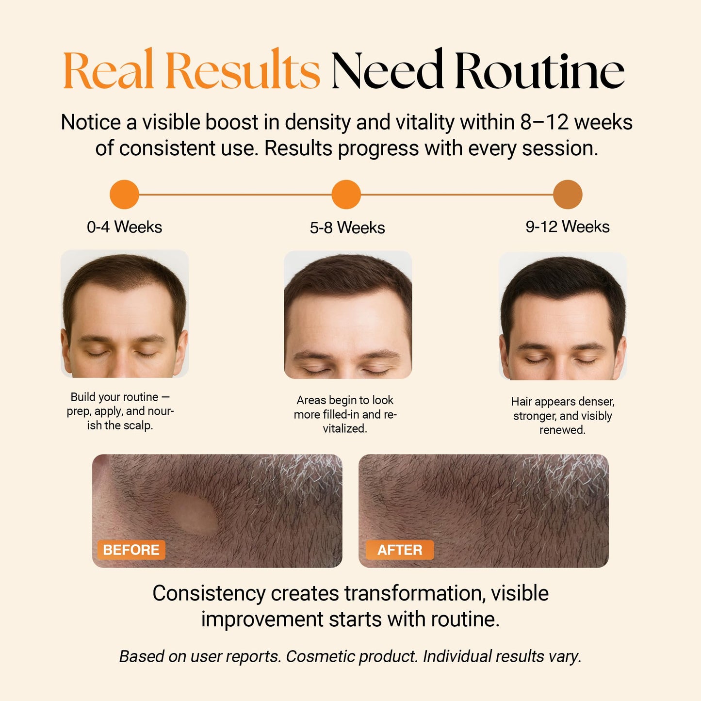 ReGlow Micro-Infusion Hair Density System | Precision Applicators & Bio-Active Serum