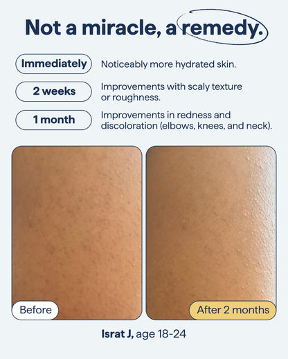 Remedy Science KP Exfoliating Body Moisturizer – Keratosis Pilaris Treatment by Dr. Shah