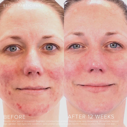 Rodan + Fields Unblemish Dual Intensive Acne Treatment | 0.76 Fl Oz | Targets Blemishes