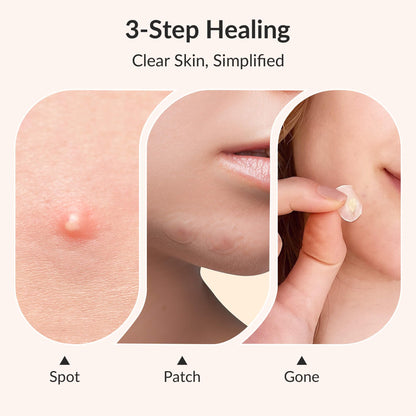 RPE Life Korean Pimple Patches – 36 Count, 4 Sizes, Hydrocolloid + Salicylic Acid