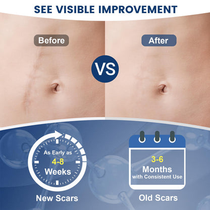 Rvlaim 100% Silicone Scar Gel – Advanced Scar Care, 1.7 oz (50 ml)