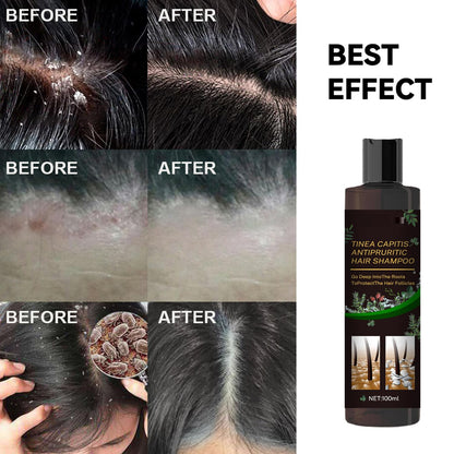 Scalp Flakes Antipruritic Shampoo – Natural Dandruff Care, Scalp Relief, 100ml