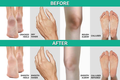 CLEAR 40% Urea Gel 4 oz with Tea Tree & Coconut Oil – Deep Hydration for Calluses, Cracked Heels, and Dry Skin | Scientific Solutions Global