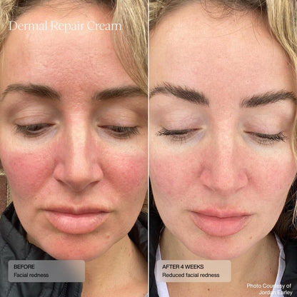 Sente Dermal Repair Facial Cream | Hydration & Soothing for Rosacea & Sensitive Skin