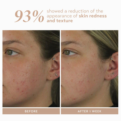 Shani Darden Rescue Serum with 10% Azelaic Complex | Lightweight Hydration