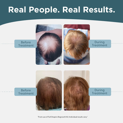 Shapiro MD Hair Growth Experts Mens Regrowth Travel Kit: 5% Minoxidil Leave-In Foamer for Thicker, Fuller Hair (1 Month)