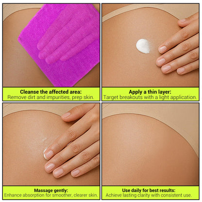 SKINBOSS Butt Acne Clearing Treatment – Hydrating Body Lotion for Back, Bum & Thighs (5 oz)