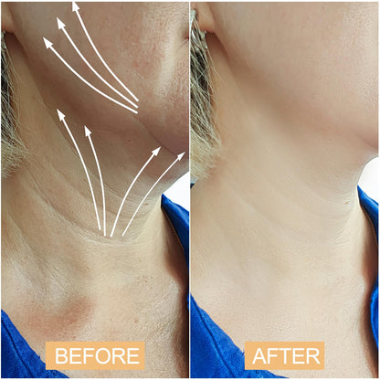 Snifflink Neck Lifting Tape – 20 Pcs for Sagging Skin & Double Chin | Invisible Adhesive