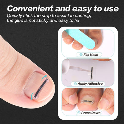 SOAOP Titanium Ingrown Toenail Tool Kit – 10-Piece Curved Nail Corrector (0.59–0.79 in)
