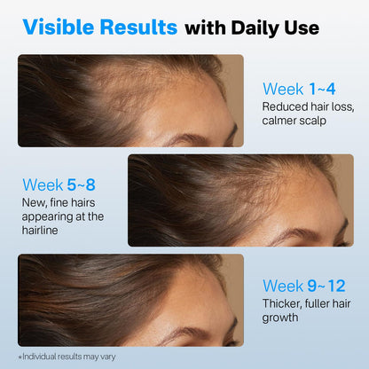 SORNBEO Hair Growth Serum Roll-On – Rosemary & Saw Palmetto, Non-Greasy Scalp Serum, 0.84 fl oz
