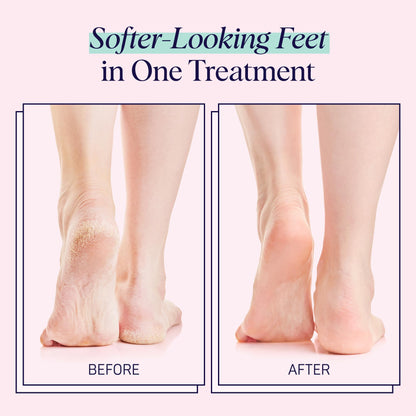 SpaLife Moisturizing Foot Sockies — Intensive Hydration Foot Mask for Dry, Cracked Feet | 8 Pack
