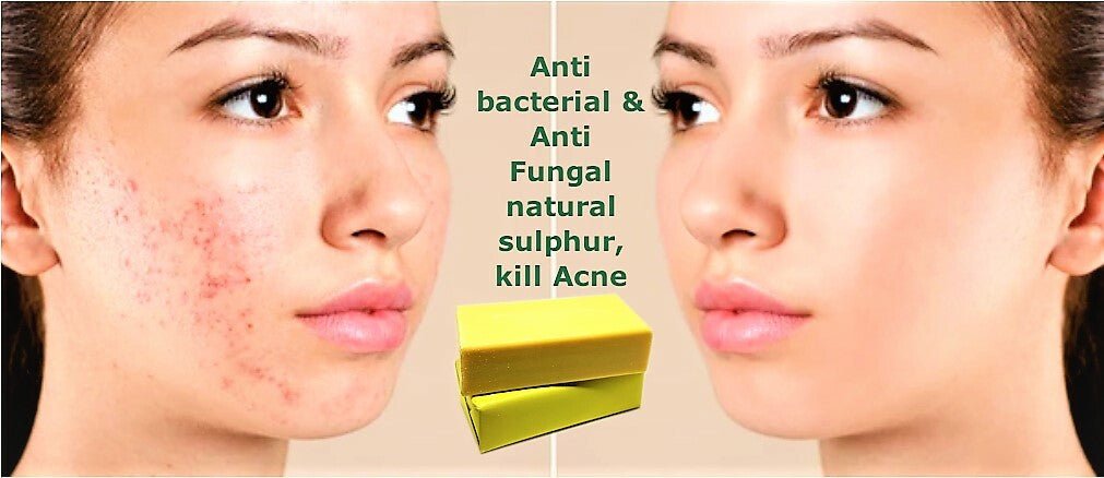 Premium Sulfur / Sulphur Soap Bar – Acne & Oily Skin Solution