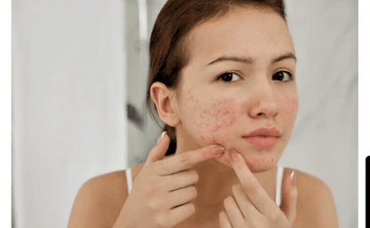 Premium Sulfur / Sulphur Soap Bar – Acne & Oily Skin Solution