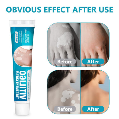 TDZLDM Vitiligo Cream - Natural White Spot Treatment for Face and Body