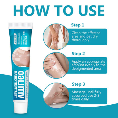 TDZLDM Vitiligo Cream - Natural White Spot Treatment for Face and Body