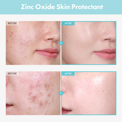 TOSOWOONG SOS Repair CICA Clinic Zinc Cream 50g – 10% Zinc Oxide for Barrier Repair & Soothing
