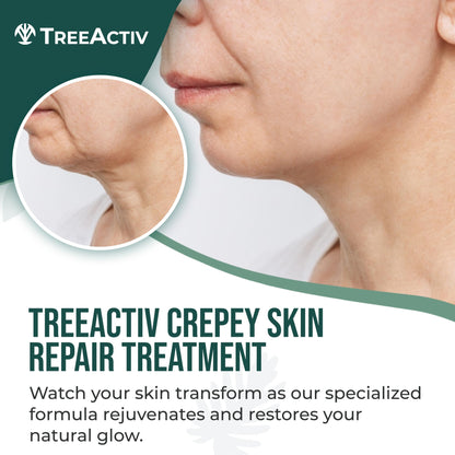 TreeActiv Crepey Skin Repair Cream – Firming Hyaluronic Acid Lotion (8 oz)