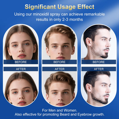 Trzsfr 5% Minoxidil Spray for Hair Growth — Extra Strength with Biotin | 12-Month 8-Pack (28 fl oz)