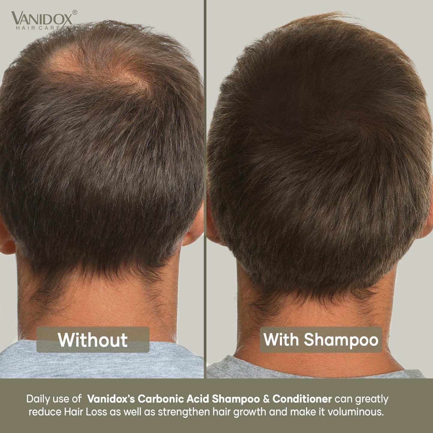 VANIDOX Carbonic Acid Shampoo with DHT Blockers — Sulfate-Free, Biotin & Tea Tree Oil (16 oz)