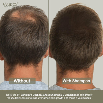 VANIDOX Carbonic Acid Shampoo with DHT Blockers — Sulfate-Free, Biotin & Tea Tree Oil (16 oz)