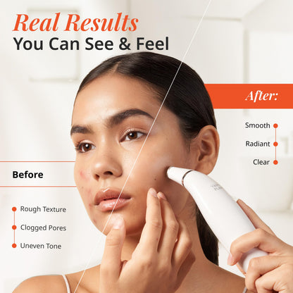 Exfora Facial Microdermabrasion Wand by Vanity Planet | 4 Interchangeable Heads, Dual Charging