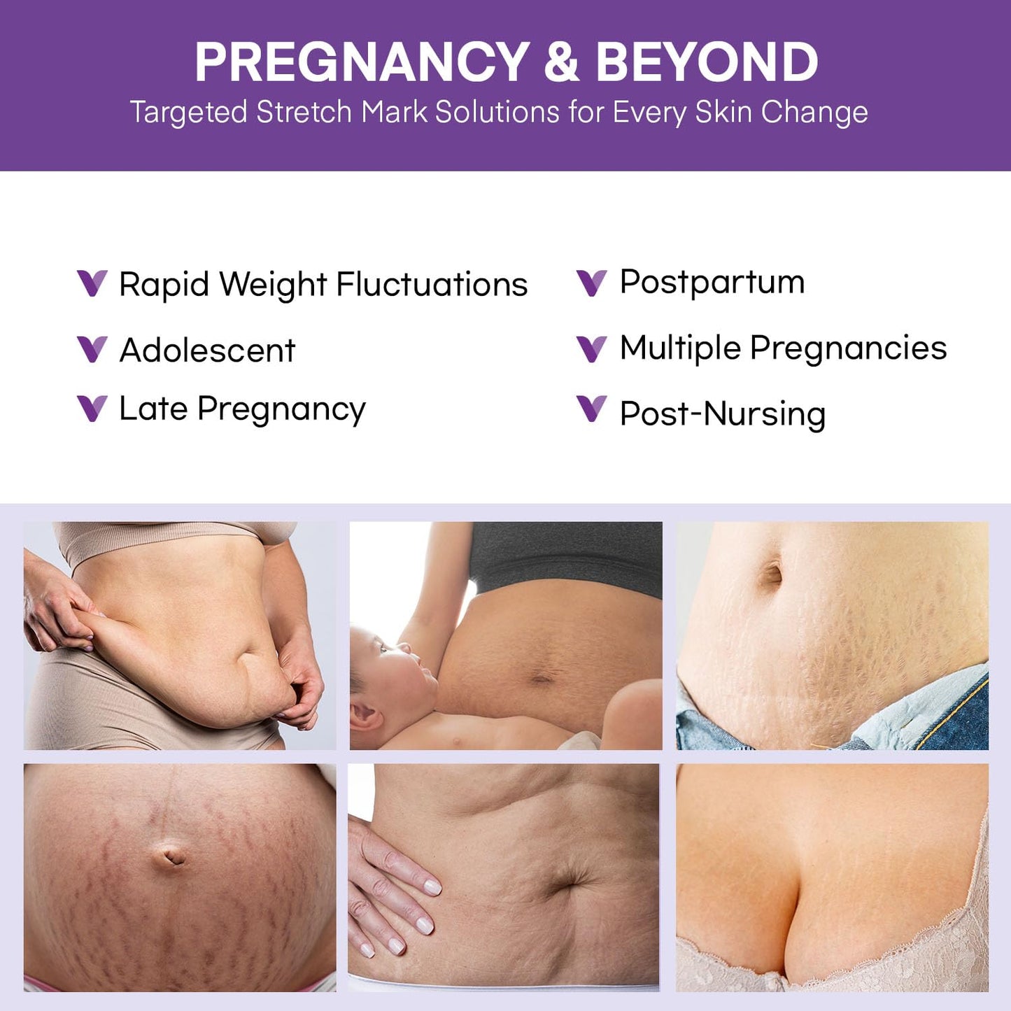 Vigority Stretch Mark Cream for Pregnancy – Belly Butter for Expecting Moms, 4 oz