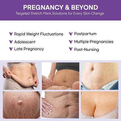 Vigority Stretch Mark Cream for Pregnancy – Belly Butter for Expecting Moms, 4 oz