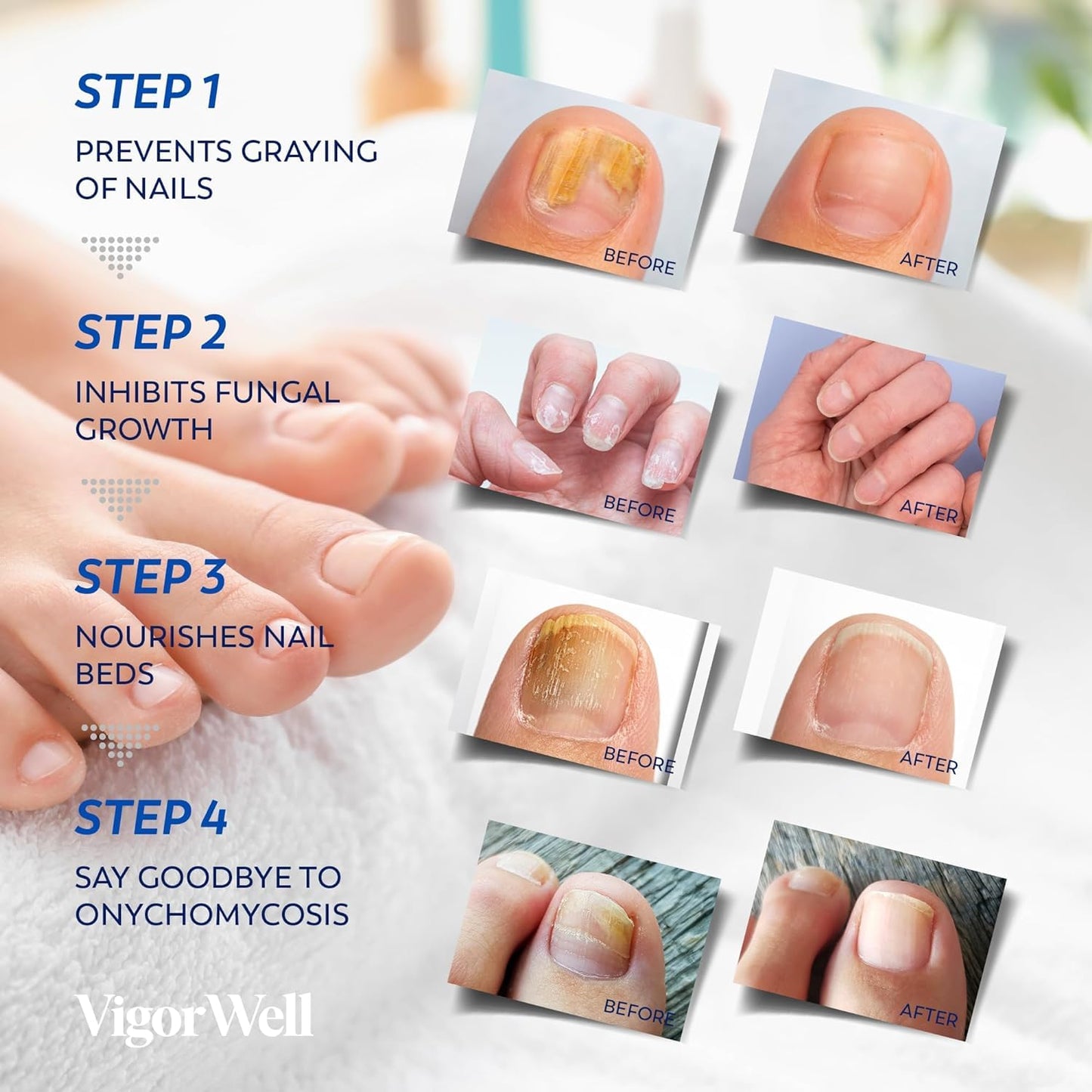 VigorWell Toenail Fungus Treatment Extra Strength – Nighttime Patches & 15ml Nail Repair Liquid (32 Patches)