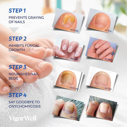 VigorWell Toenail Fungus Treatment Extra Strength – Nighttime Patches & 15ml Nail Repair Liquid (32 Patches)