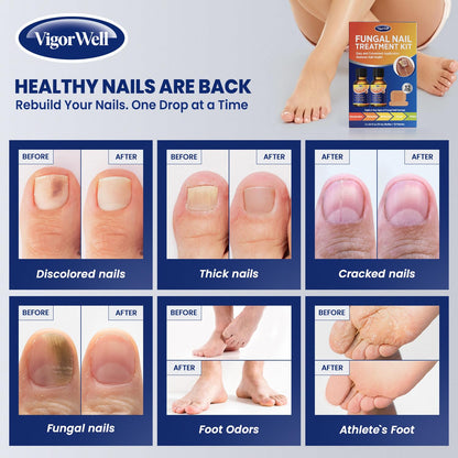 VigorWell Toenail Treatment Extra Strength – Dual Action Nail Repair Kit (30 ml Gel + 32 Patches)