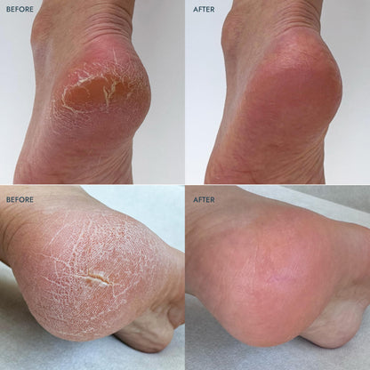 VOESH Solemate Heel Repair Balm – Lavender | Deep Moisturizing Foot Care for Rough Heels