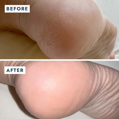VOESH Solemate Heel Repair Balm – Deep Moisture for Rough Heels