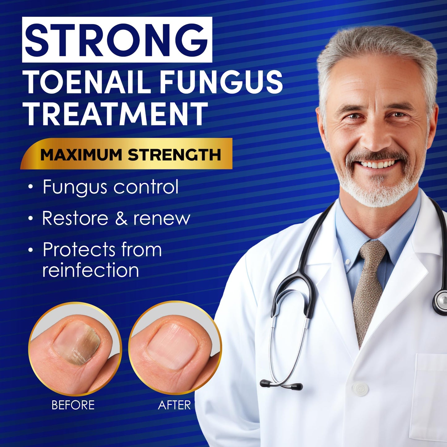VTROUY Toenail Fungus Treatment Extra Strength – 25% Undecylenic Acid & Tea Tree Oil