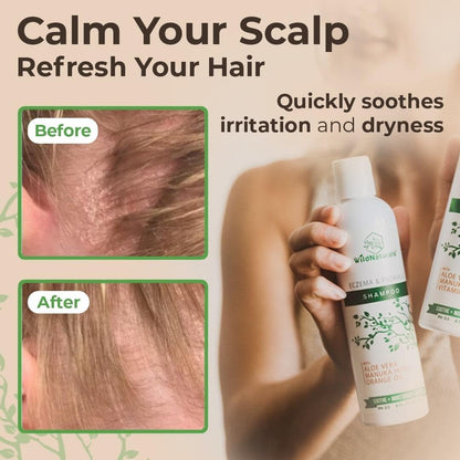 Wild Naturals Eczema & Psoriasis Treatment Shampoo – Hypoallergenic & Fragrance-Free