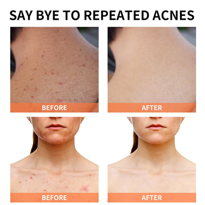 YAFUSIPE Acne Treatment Cream for Cystic Breakouts – Gentle, All-Skin-Types Formula