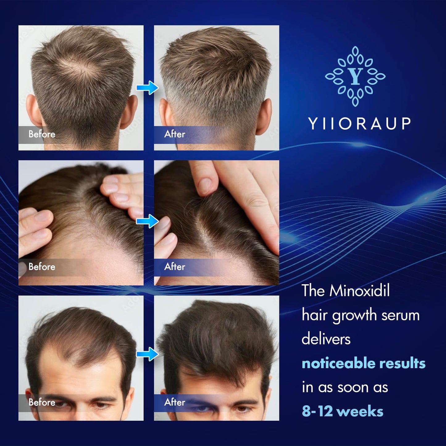 YIIORAUP 5% Minoxidil Hair Growth Solution – Extra Strength Topical for Men & Women (Biotin) – 2-Pack